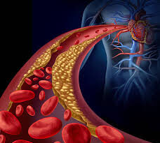 ارتفاع الكولسترول..تعرف على الأسباب والمضاعفات والعلاج