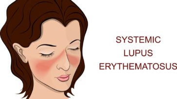 الذئبة الحمراء و 3 طرق للوقاية منها