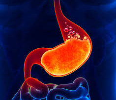 الارتجاع المعدي المريئي