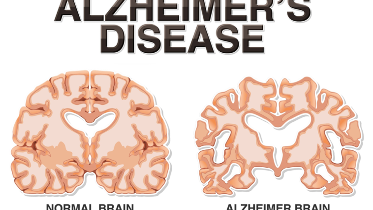 مرض الزهايمر