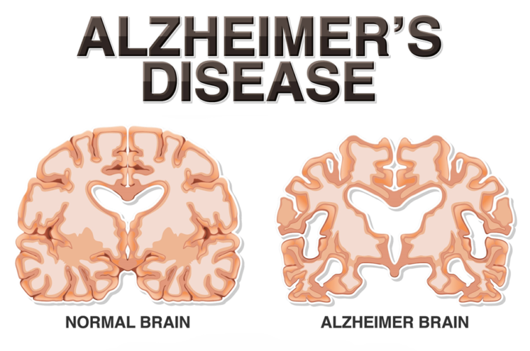 مرض الزهايمر