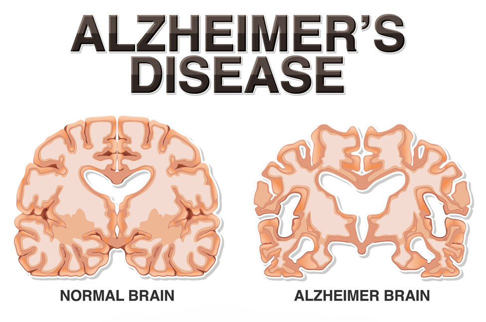 مرض الزهايمر