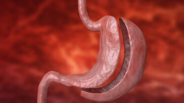 جراحة تكميم المعدة