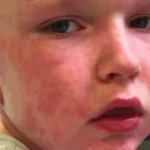 أسباب وأعراض الحساسية عند الأطفال و3 طرق لعلاجها