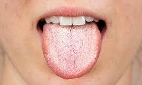 القلاع الفموي ( oral thrush) و3 أعراض مميزة له