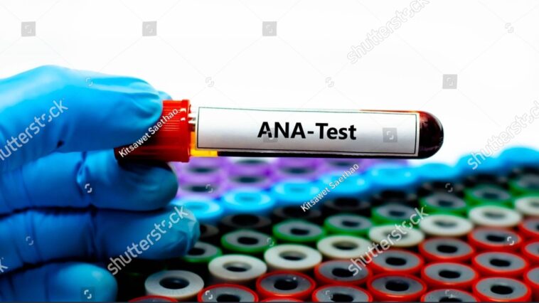 تحليل الأجسام المضادة للنواة