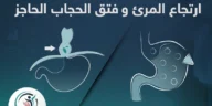 تعرف على الشكل لحالتى ارتجاع المرئ وفتق الحجاب الجاجز