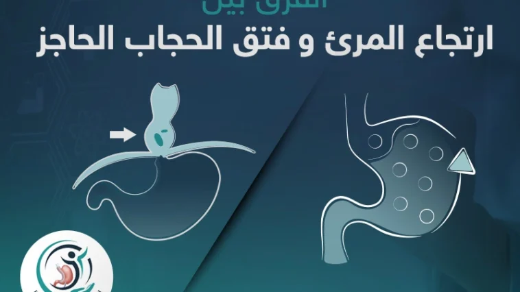 تعرف على الشكل لحالتى ارتجاع المرئ وفتق الحجاب الجاجز