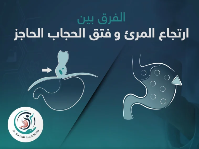 تعرف على الشكل لحالتى ارتجاع المرئ وفتق الحجاب الجاجز