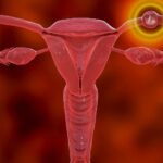 الحمل خارج الرحم