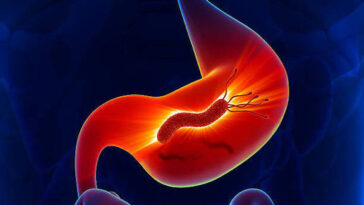 بكتيريا المعدة (H. Pylori)