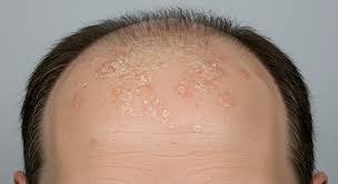 التهاب الجلد الدهني