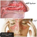 الفرق بين حساسية الأنف والتهاب الجيوب الأنفية