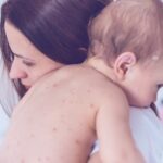 مرض الجدري المائي