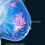 سرطان الثدي