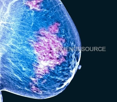 سرطان الثدي