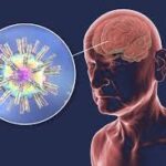 التهاب الدماغ