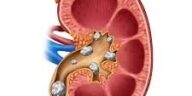 حصوات الكلى واهم 3 طرق لعلاجها