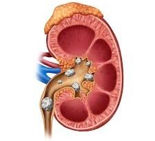 حصوات الكلى واهم 3 طرق لعلاجها