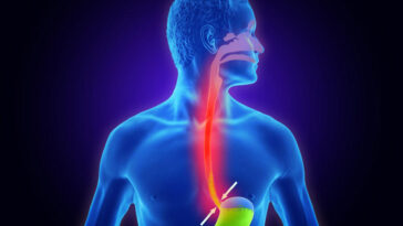 ارتجاع المرئ