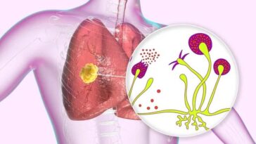 مرض الفطر الأسود