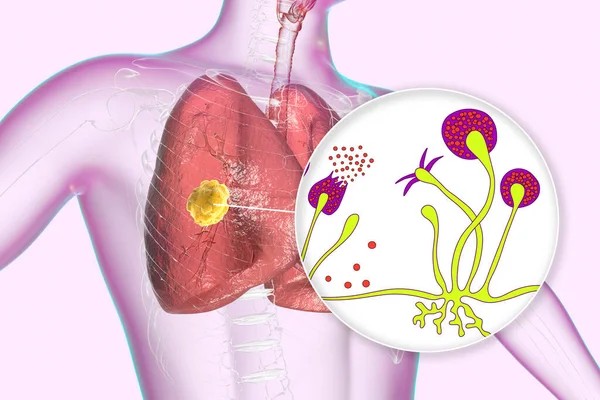مرض الفطر الأسود