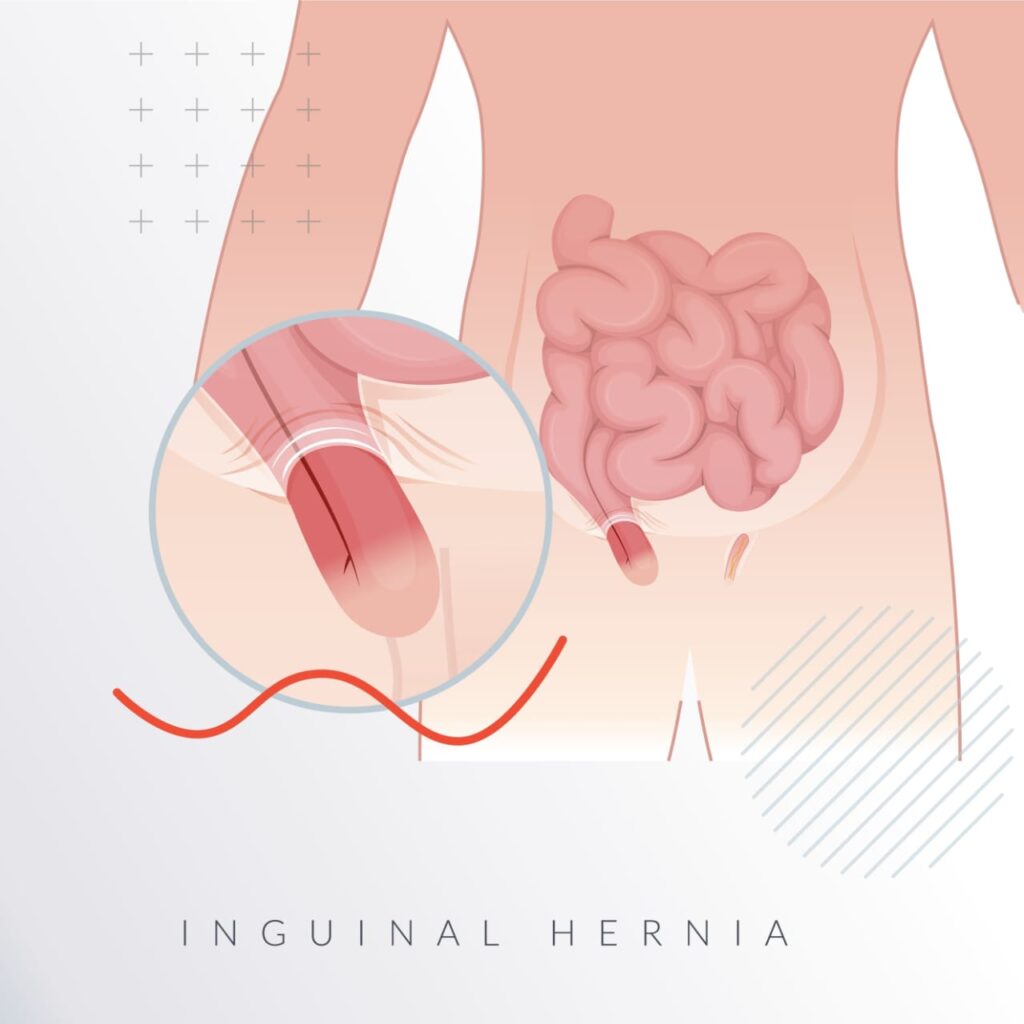 الفتق الإربي (Inguinal Hernia)
