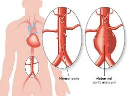 تمدد الشريان الأورطي البطني (AAA): الأعراض الصامتة، وعوامل الخطر، ومتى يصبح التدخل ضروريًا؟