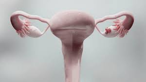 كيس الشيكولاتة على المبيض 
chocolate cyst