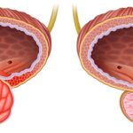 تضخم البروستاتا الحميد