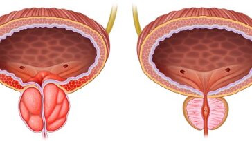 تضخم البروستاتا الحميد