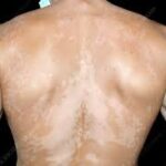 التينيا الملونة